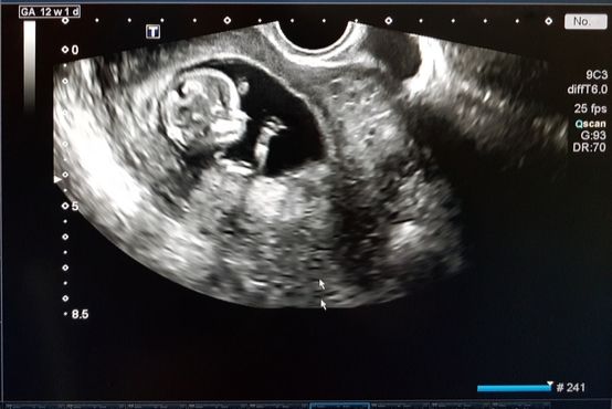Biometrické míry plodu na ultrazvuku: tabulka hodnot a význam zkratek